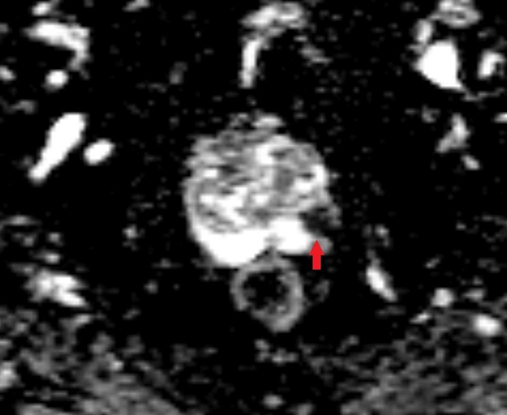 multiparametrische Prostata-MRT in der Vorsorge mit kleinem Prostatakarzinom im ADC-Mapping multiparametrische Prostata-MRT in der Vorsorge mit kleinem Prostatakarzinom im ADC-Mapping