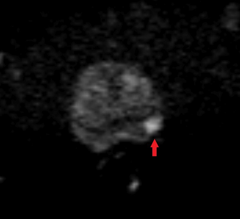multiparametrische Prostata-MRT in der Vorsorge mit kleinem Prostatakarzinom in der Diffusion multiparametrische Prostata-MRT in der Vorsorge mit kleinem Prostatakarzinom in der Diffusion