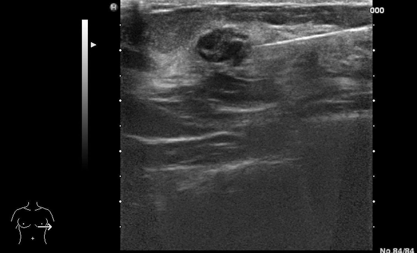 sonographisch gesteuerte Stanzbiopsie bei Verdacht auf Brustkrebs sonographisch gesteuerte Stanzbiopsie bei Verdacht auf Brustkrebs