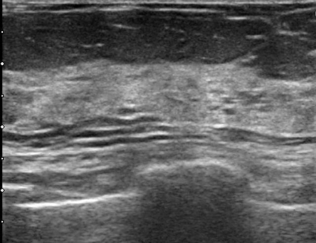unauffällige Mammasonographie (Brustultraschall/Brustsonographie) zur Früherkennung (Vorsorge) von Brustkrebs unauffällige Mammasonographie (Brustultraschall/Brustsonographie) zur Früherkennung (Vorsorge) von Brustkrebs