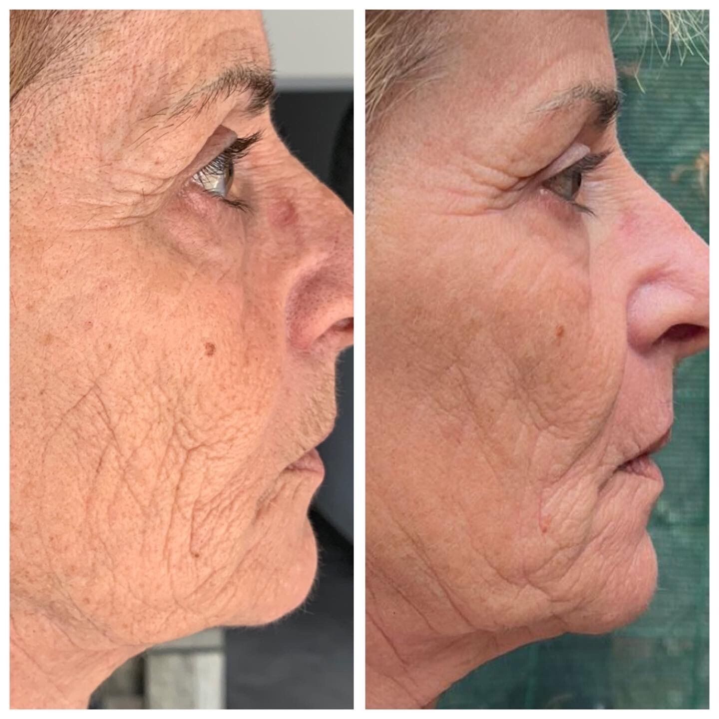 plasma lift , fibroblast skin tightening, plasM, Plasma pen, lifting sans chirurgie