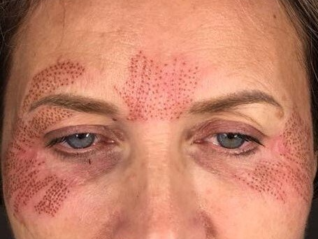 résultat après la séance soin plasma lift plas m juste après la séance