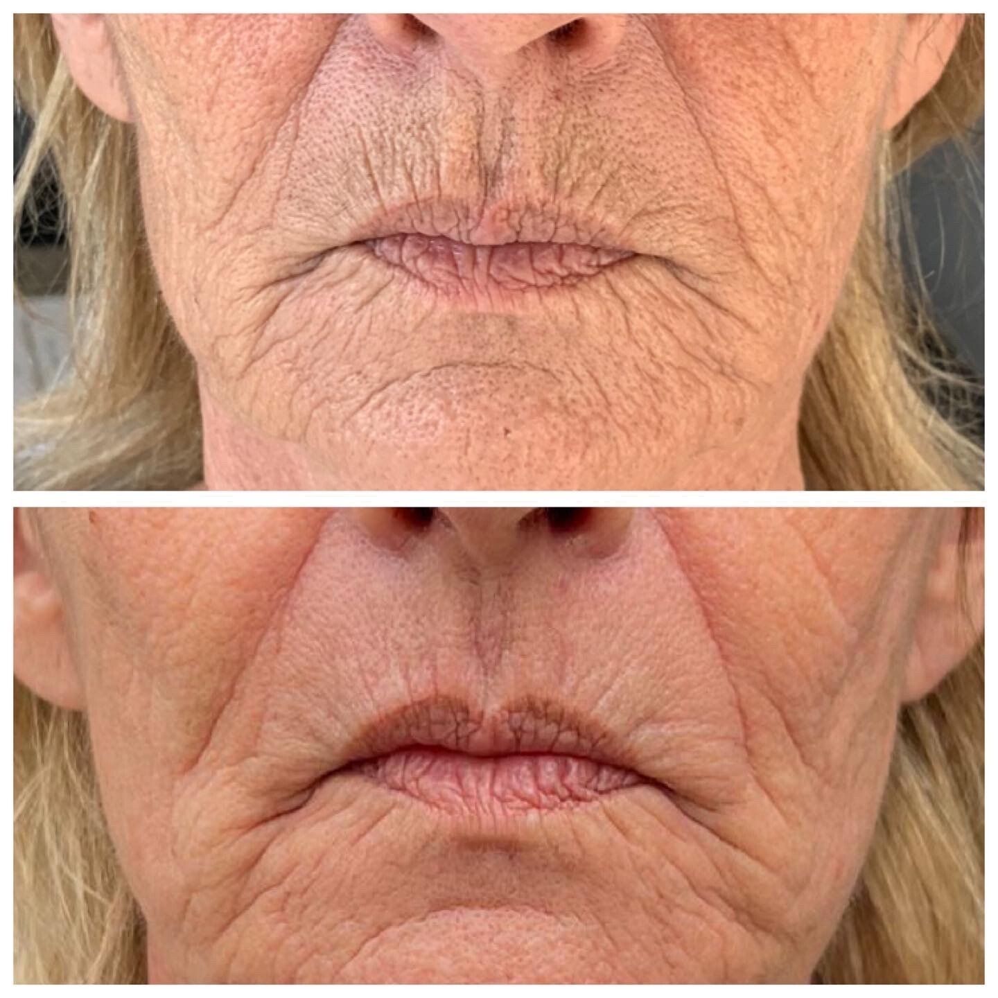 plasma lift , fibroblast skin tightening, plasM, Plasma pen, lifting sans chirurgie