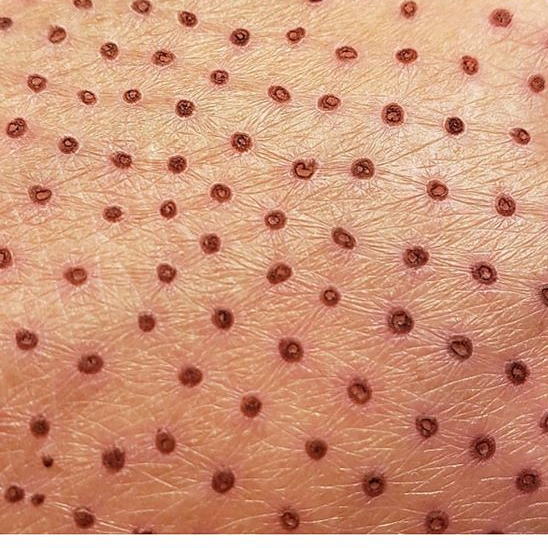 plasma lift ou lifting sans chirurgie