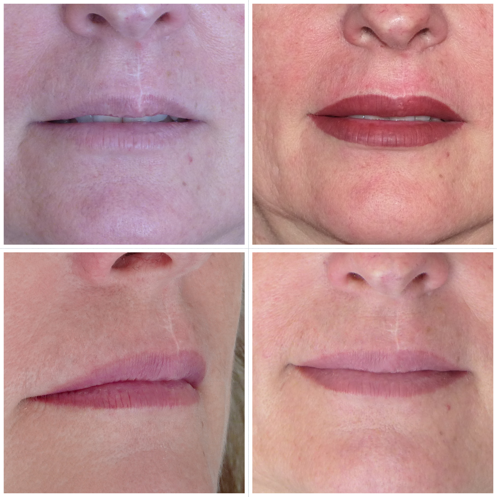 dermopigmentation médicale, cicatrice bouche