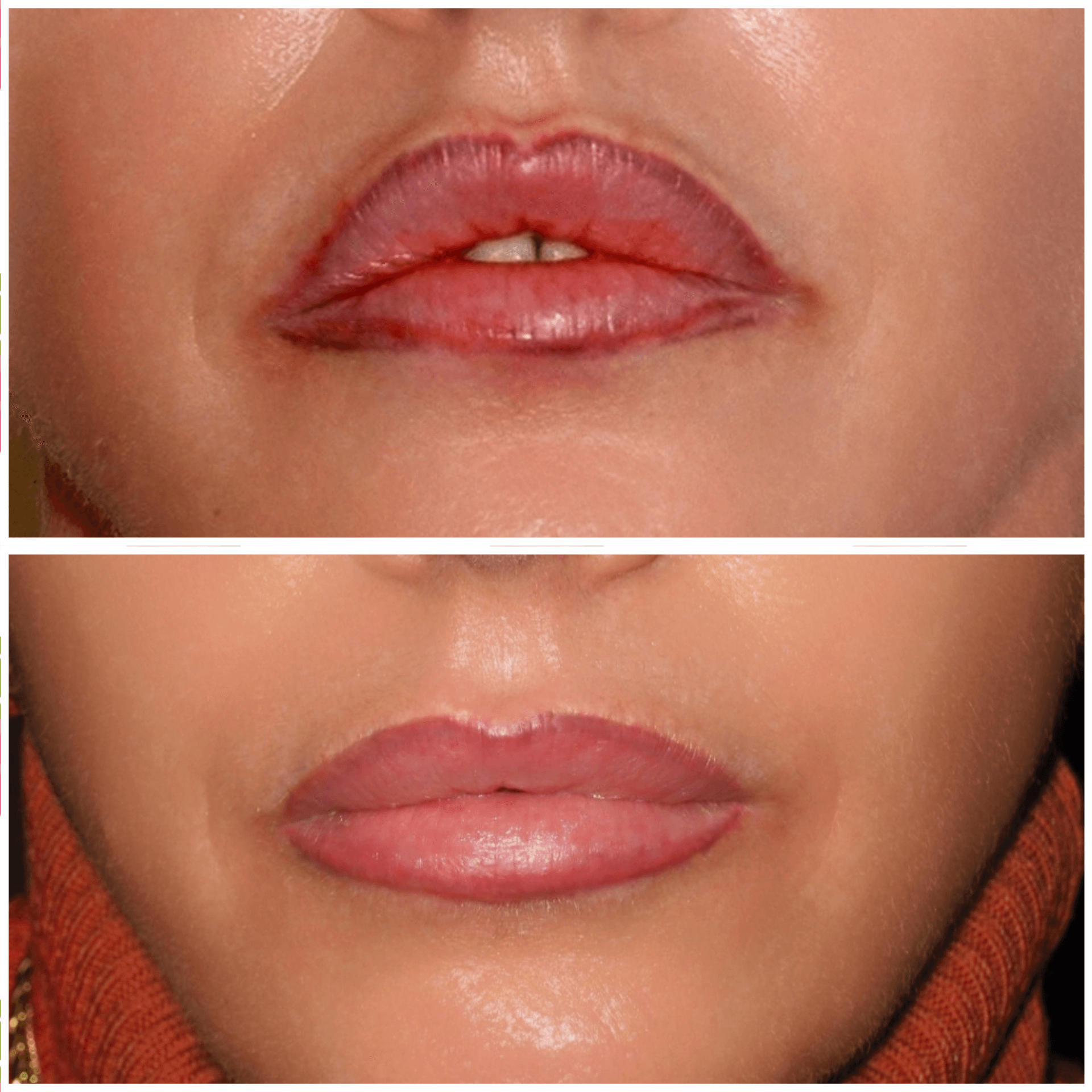 correction d'un maquillage permanent raté par détatouage sans laser ou pigment killer