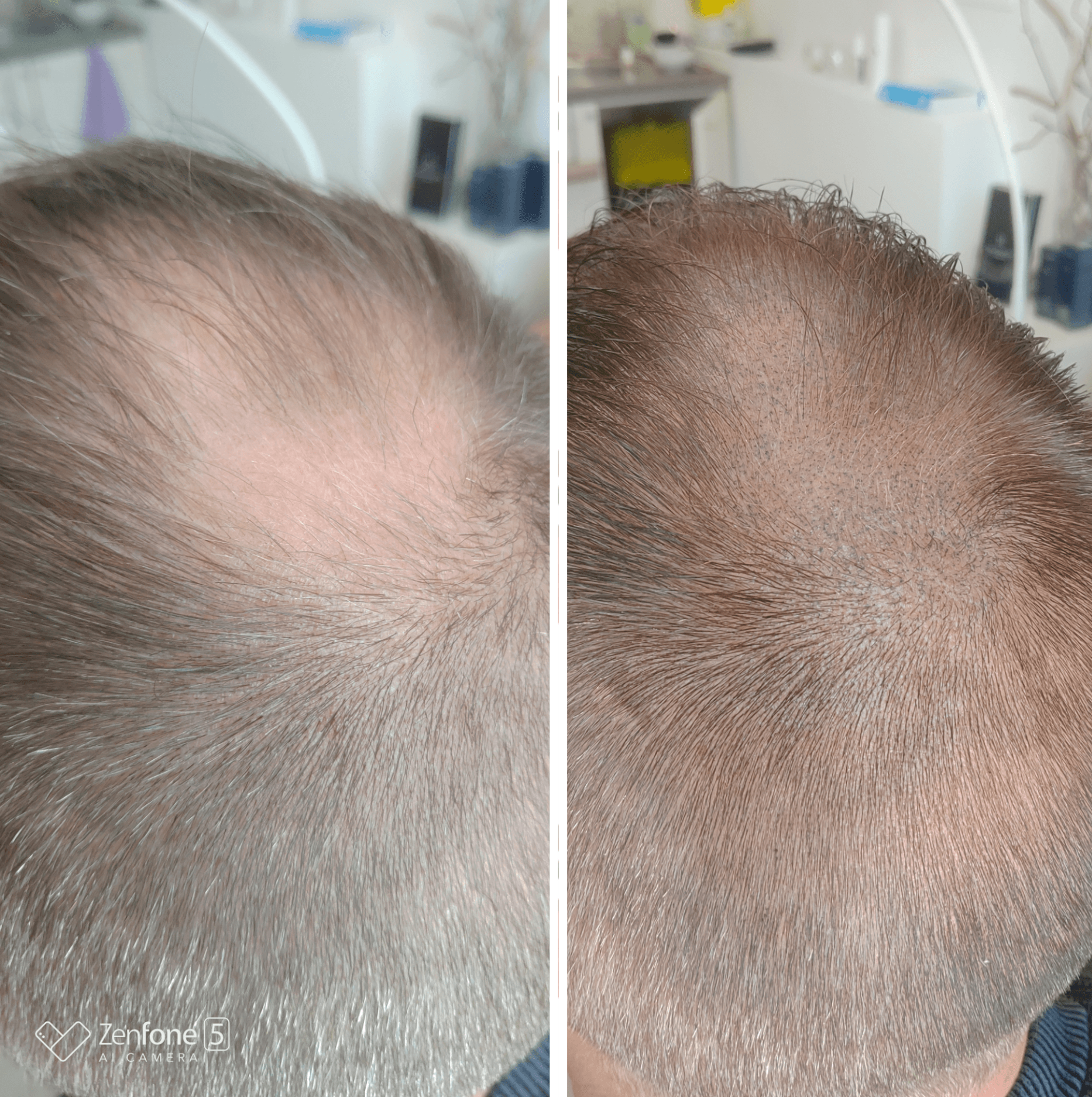micropigmentation capillaire, camouflage de la calvitie ou pelade  par dermopigmentation du cuir chevelu ou SMP