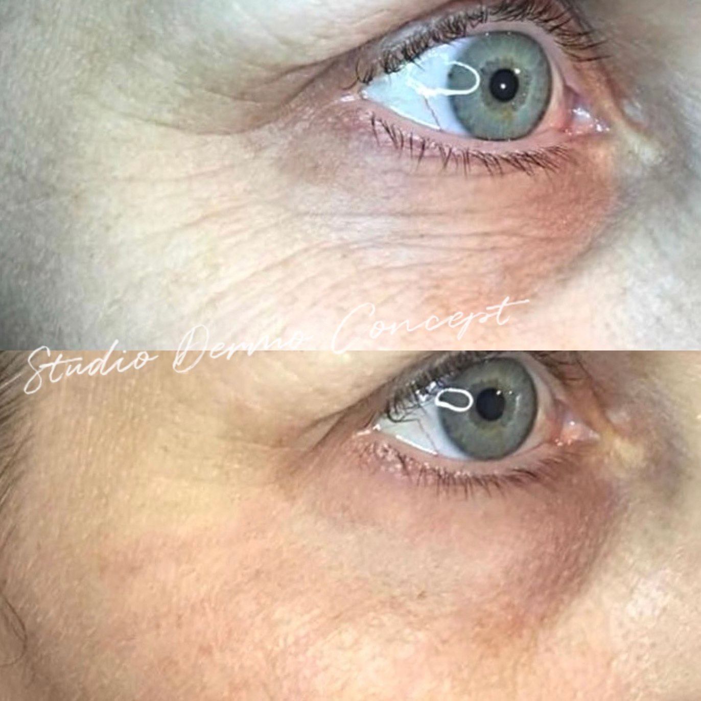 plasma lift , rajeunissement, lifting , sans chirurgie, rides, taches