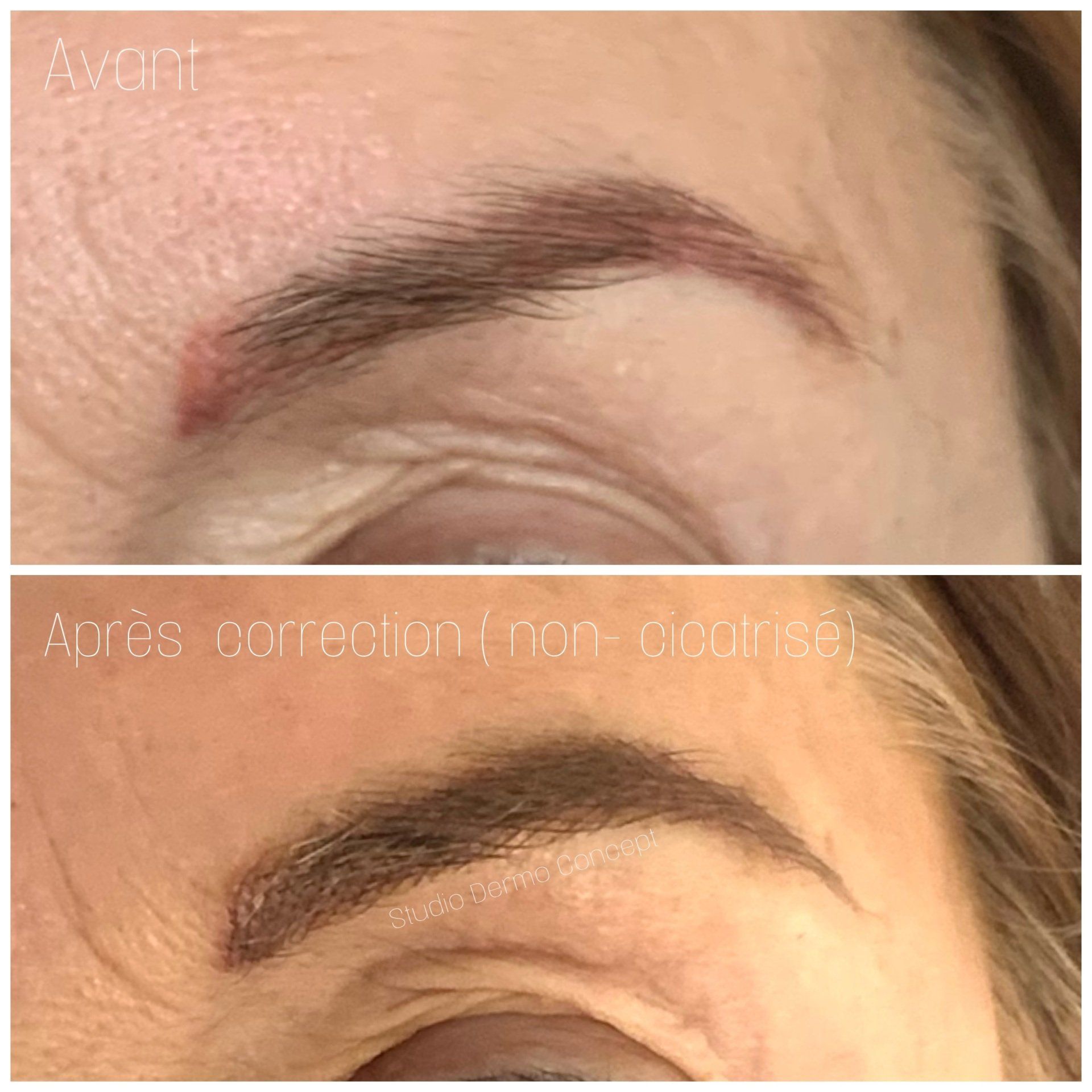 Correction de dermopigmentation ratée