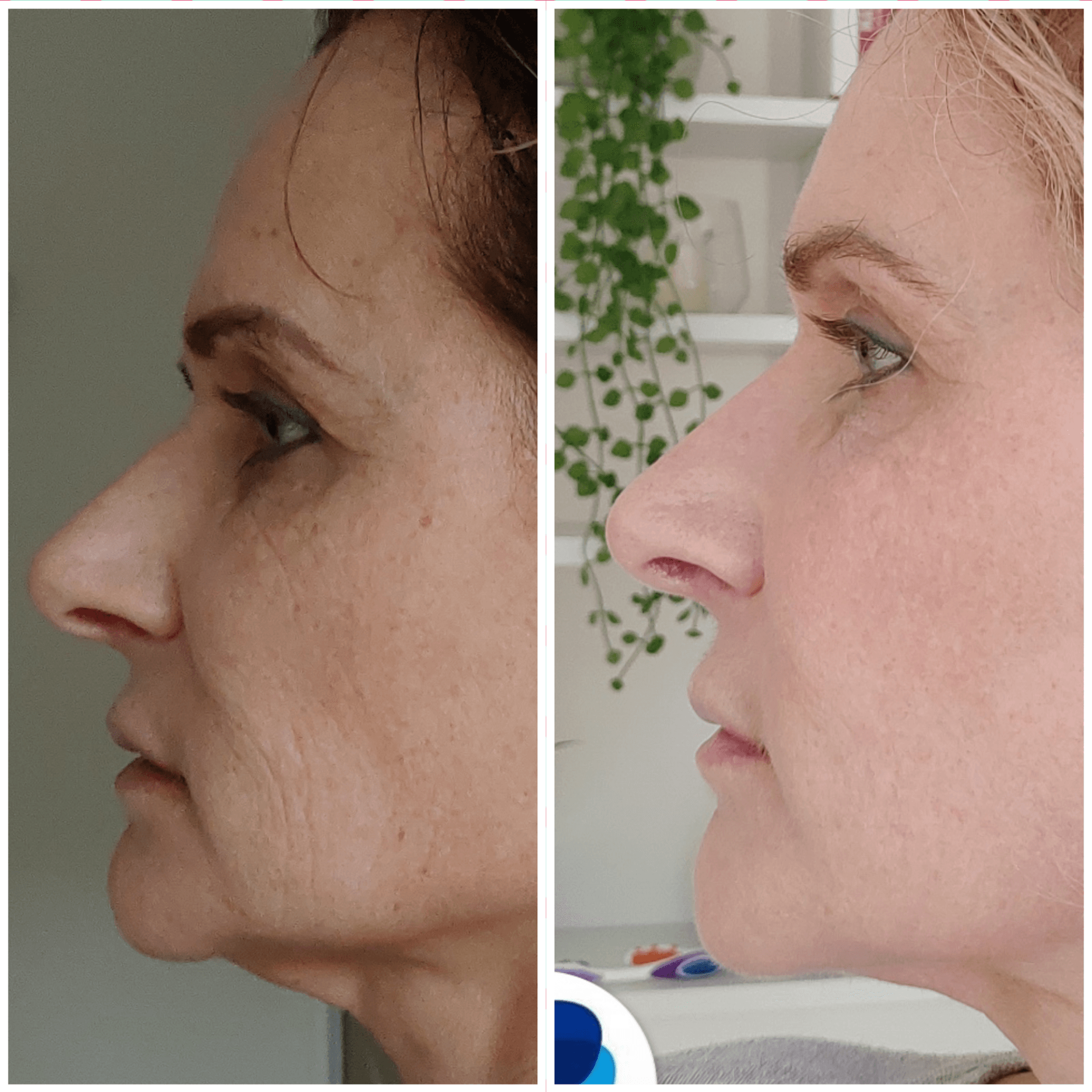plasma lift , fibroblast skin tightening, plasM, Plasma pen, lifting sans chirurgie