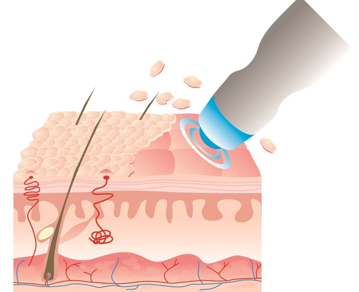 Cliquez pour agrandir technique microdermabrasion aux micro-cristaux de diamant