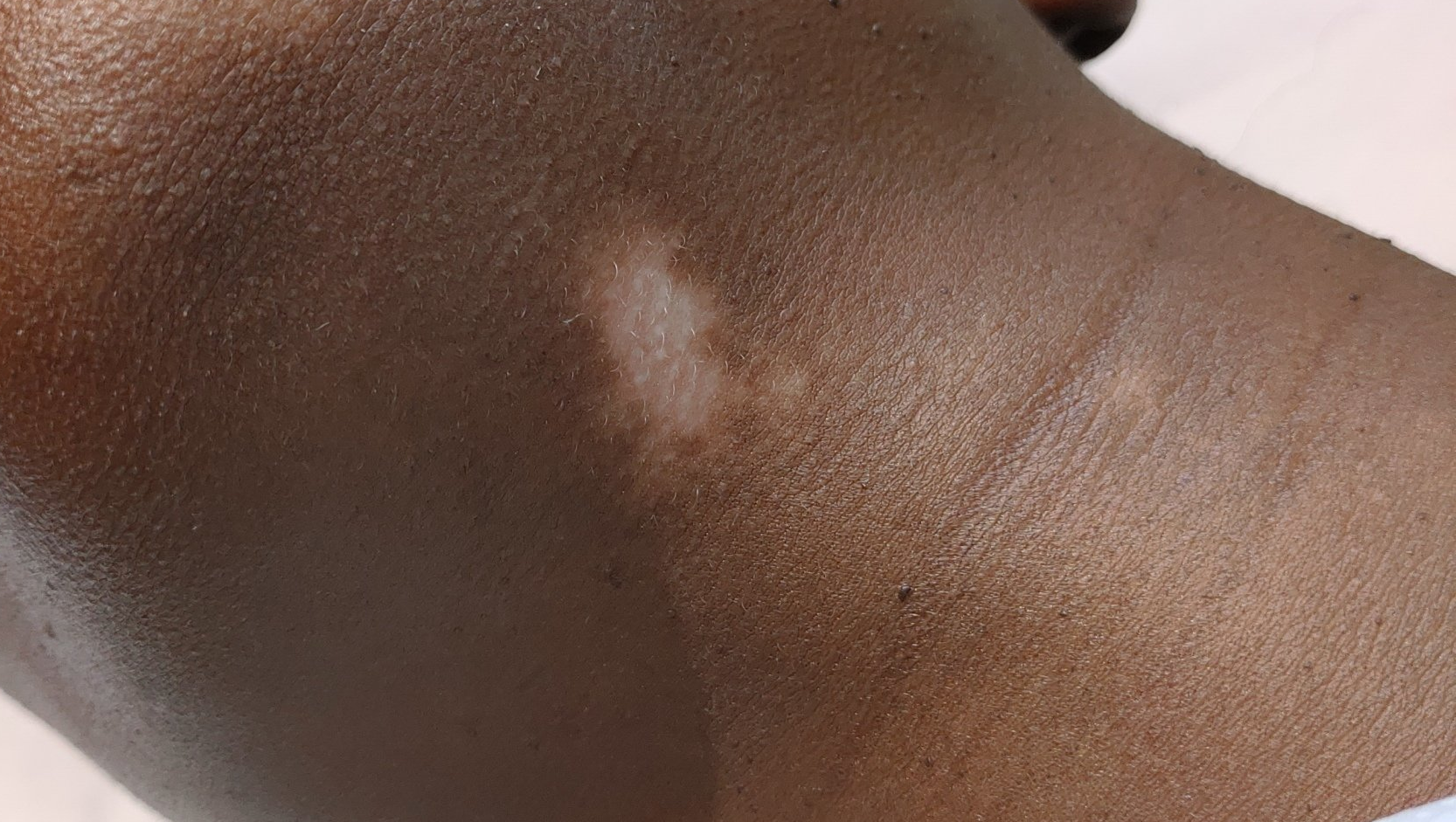 dermopigmentation sur vitiligo