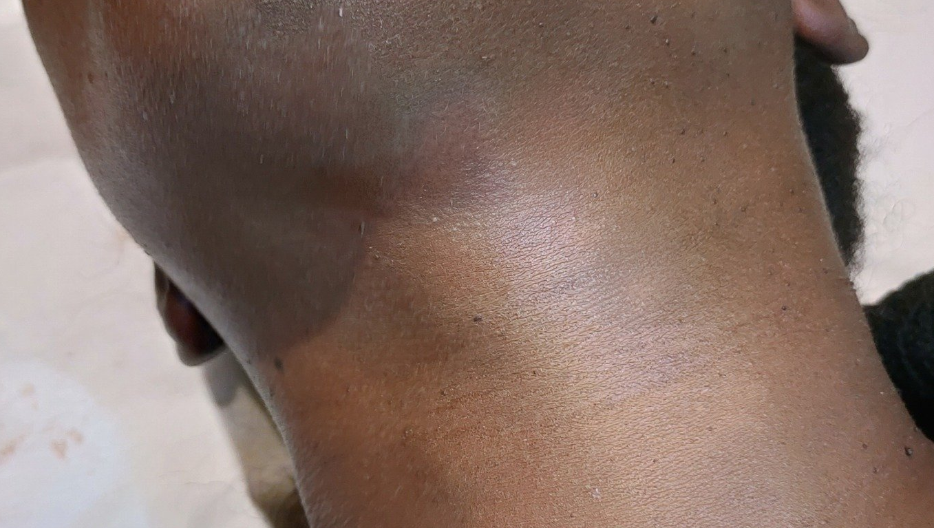 dermopigmentation de vitiligo