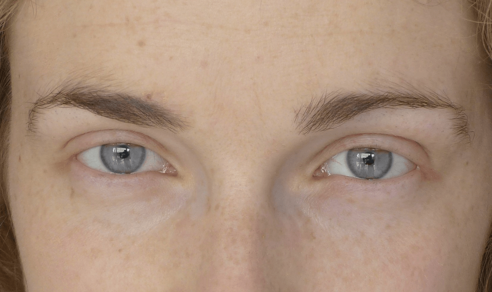 En cas d'alopécie pelade trichotillomanie, la dermopigmentation permet de redessiner la ligne des cils et redonner de l'intensité au regard