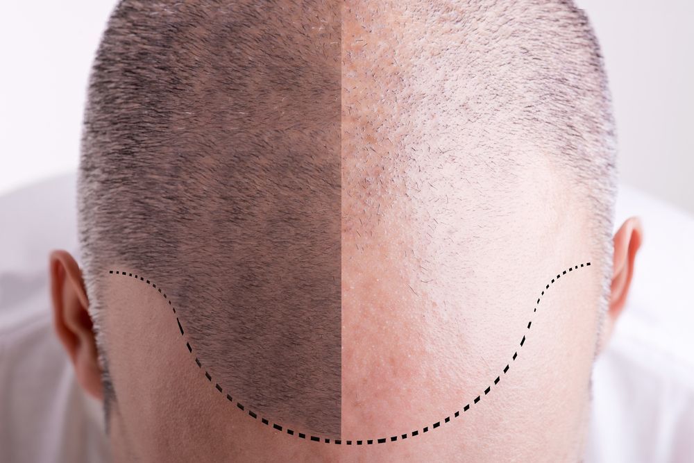 micropigmentation capillaire, tatouage cheveux effet 