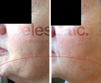 soin visage anti-âge, soin multi-technique, soin médi-esthétique Celestetic, avec microdermabrasion, peeling et microneedling