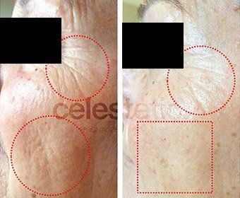 soin visage anti-âge, soin multi-technique, soin médi-esthétique Celestetic,  avec microdermabrasion, peeling et microneedling