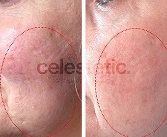 soin visage anti-âge, soin multi-technique, soin médi-esthétique Celestetic, avec microdermabrasion, peeling et microneedling