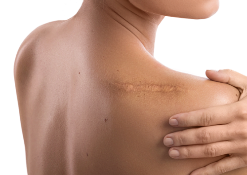 correction cicatrices