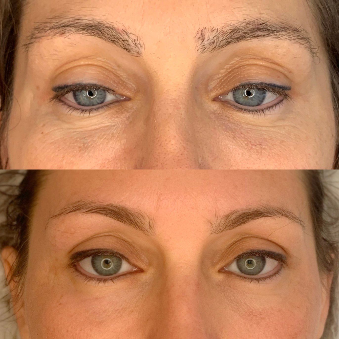 plasma lift, lifting sans chirurgie