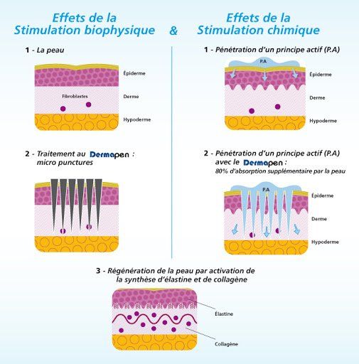 Cliquez pour agrandir microneedling, stimulation biophysique et chimique