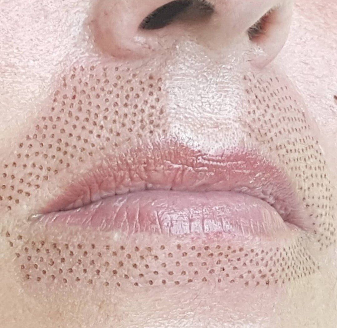 soin plasma lift plas m juste après la séance