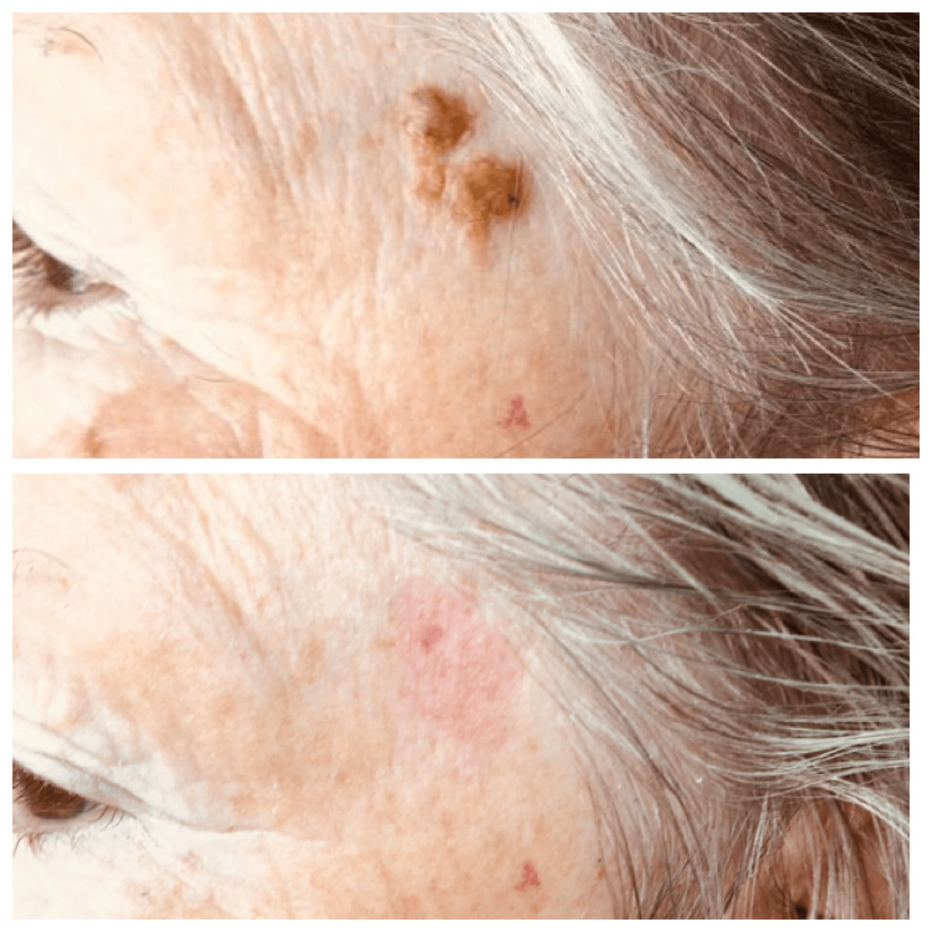 plasma, plasma pen, kératose séborrhéique, kératose, traitement kératose