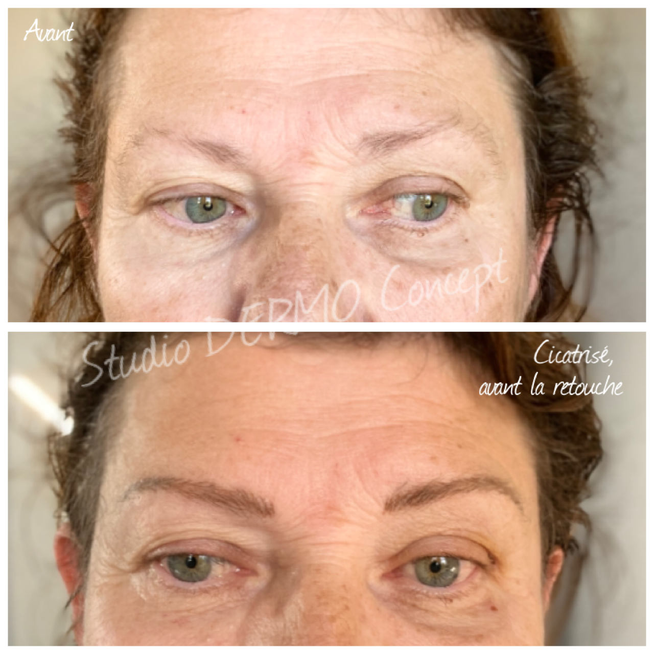 sourcils poil à poil cicatrisés