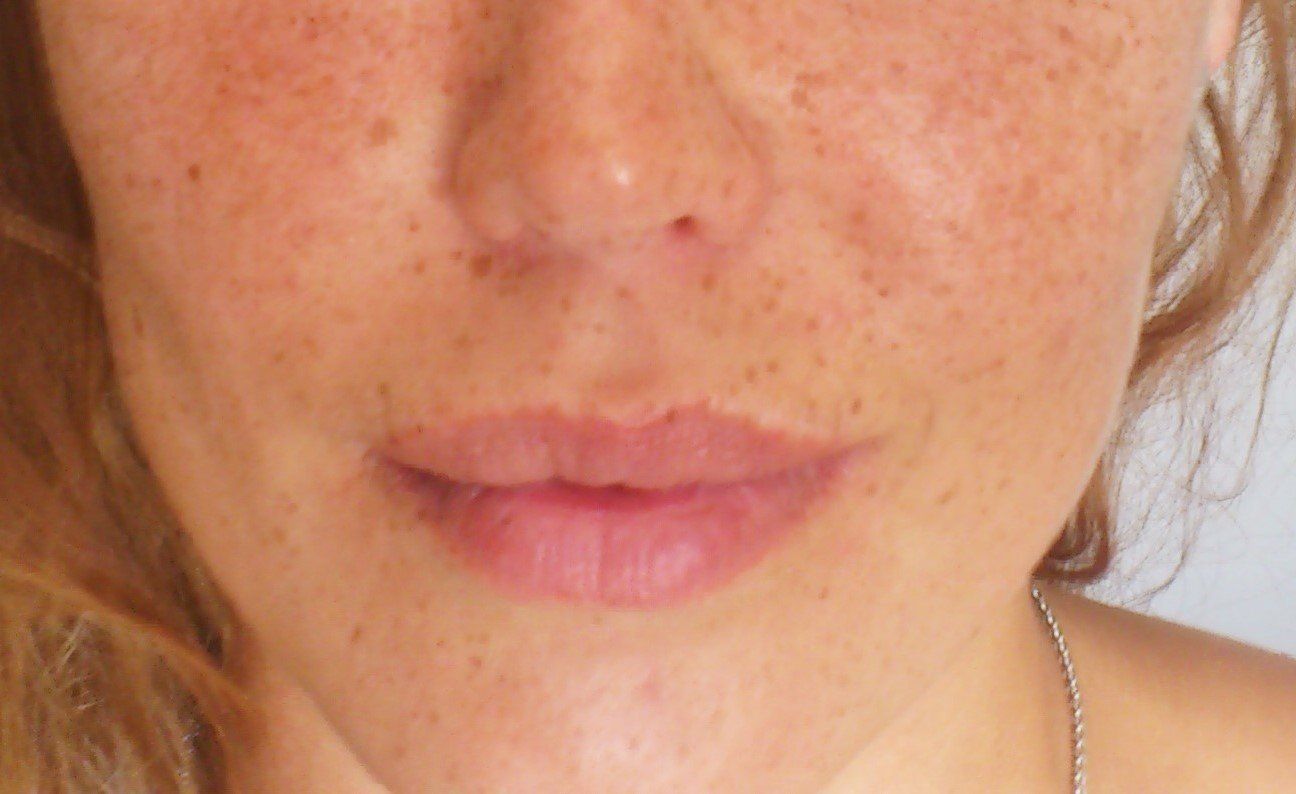 pigmentation des lèvres correction de cicatrices