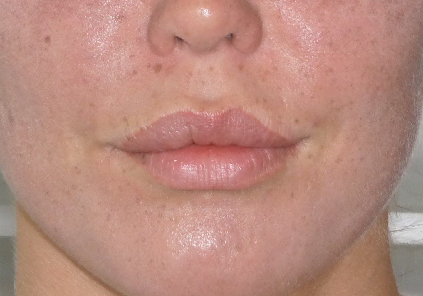 pigmentation des lèvres, correction de cicatrice