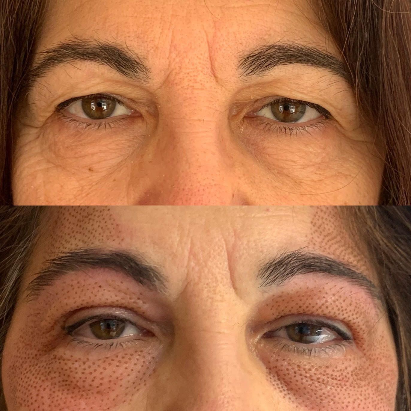 blépharoplastie sans chirurgie, plasma lift, paupière