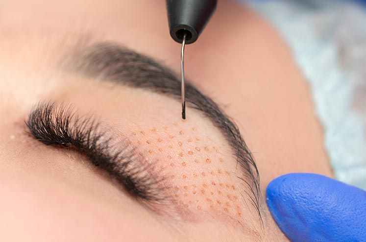 plasma lift, lifting sans chirurgie, blépharoplastie