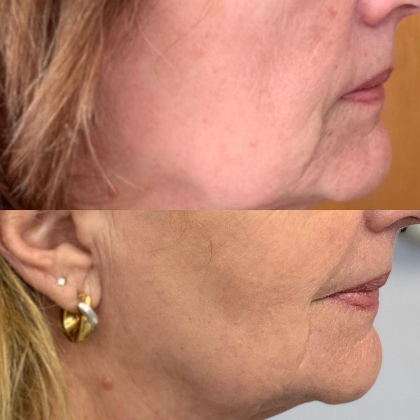 rajeunissement de la peau, lifting sans chirurgie, ovale du visage
