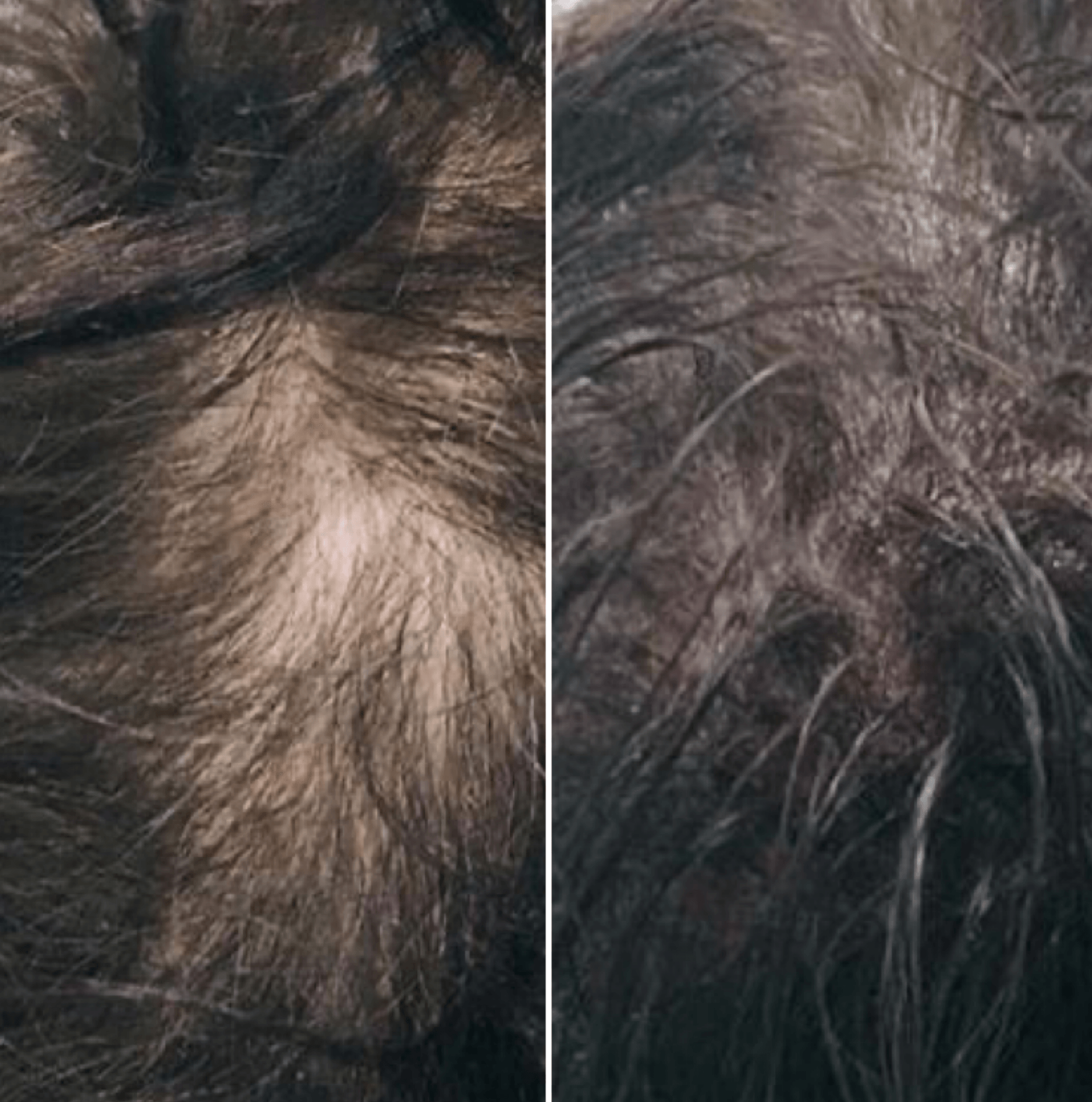 Densification capillaire par pigmentation du cuir chevelu après pelade ou calvitie