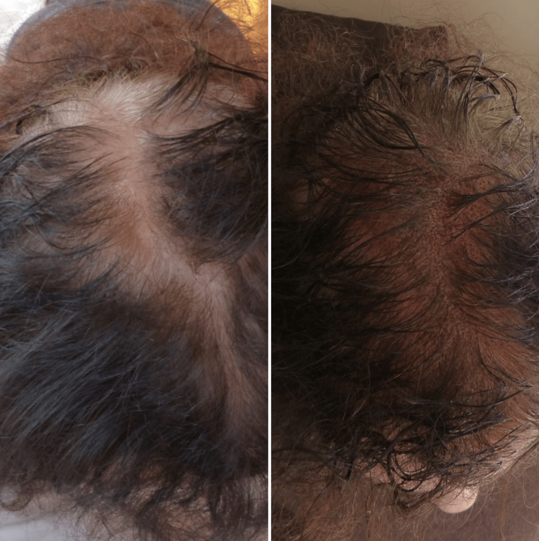 Densification capillaire par pigmentation du cuir chevelu après pelade ou calvitie