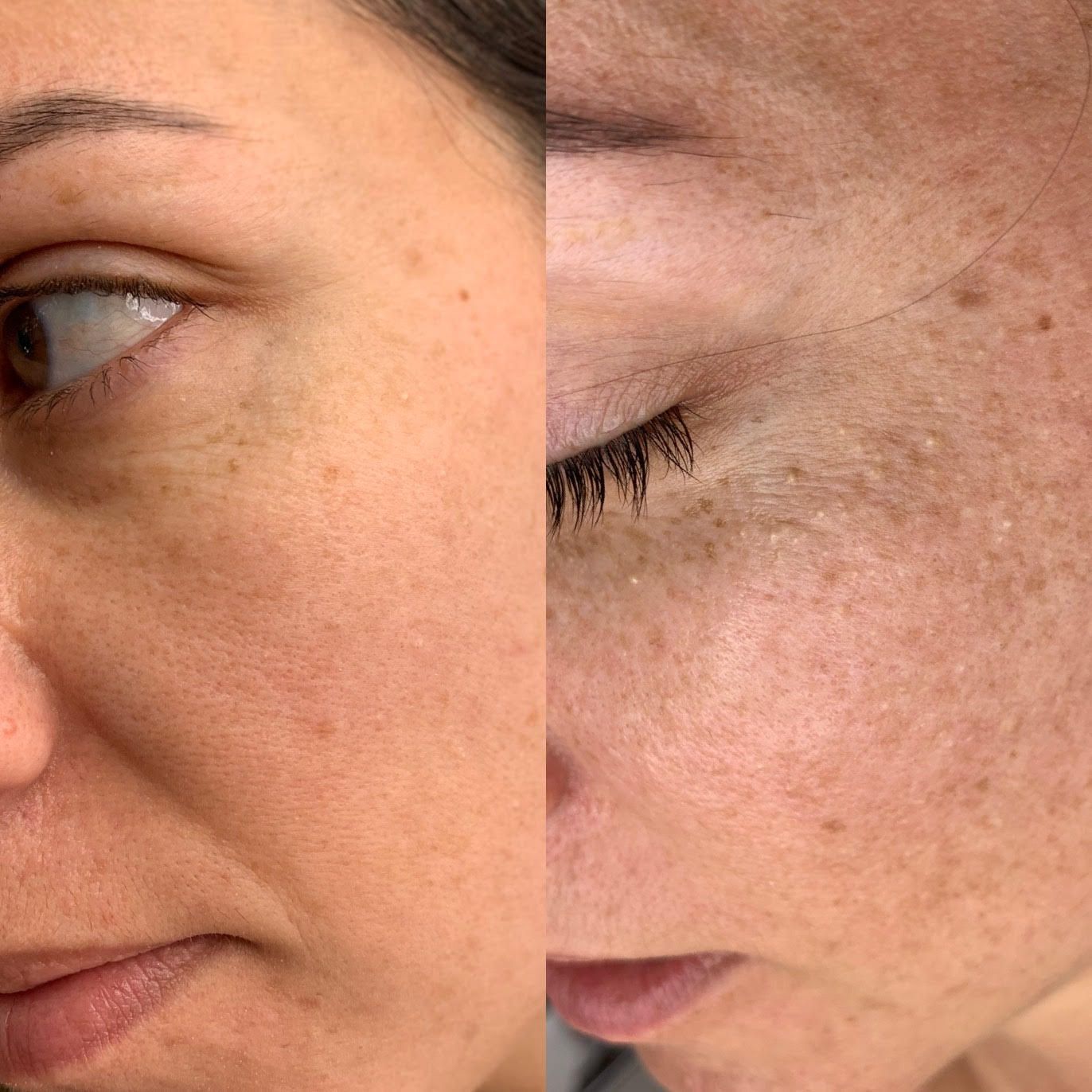 Soin multi-technique, celestetic, hydrapeel, dermabrasion, peeling, microneedling, béta-glucan, led, photothérapie