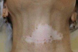 dermopigmentation camouflage vitilgo. Défaut de mélanine