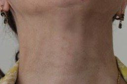 dermopigmentation camouflage vitilgo. Défaut de mélanine