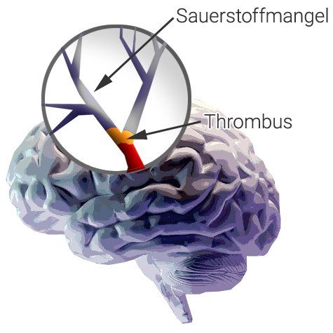 Ischämischer Schlaganfall (Hirninfarkt) Ischämischer Schlaganfall (Hirninfarkt)