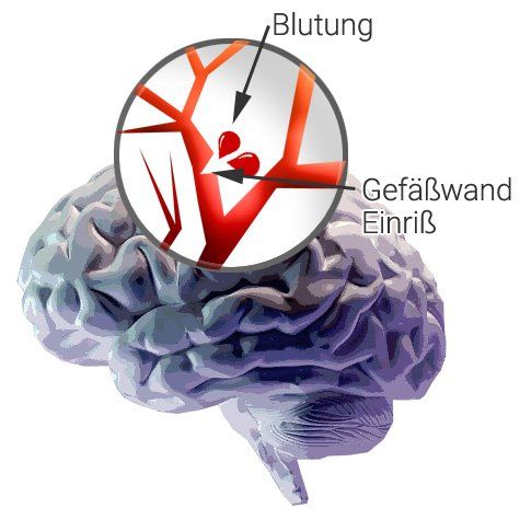 Hämorrhagischer Schlaganfall (Hirnblutung) Hämorrhagischer Schlaganfall (Hirnblutung)