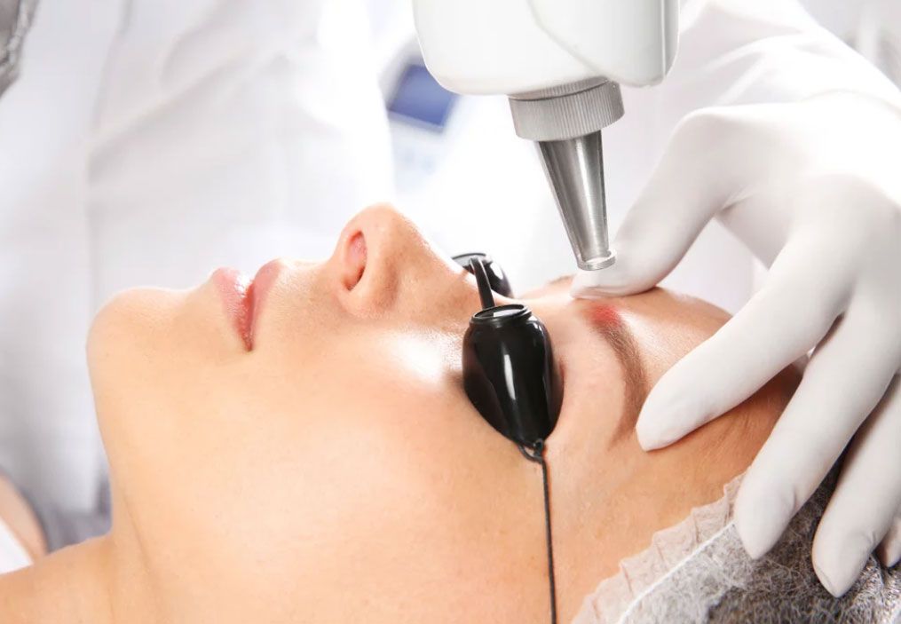 Laser Eyebrow Tattoo Removal - Book Your Consultation now