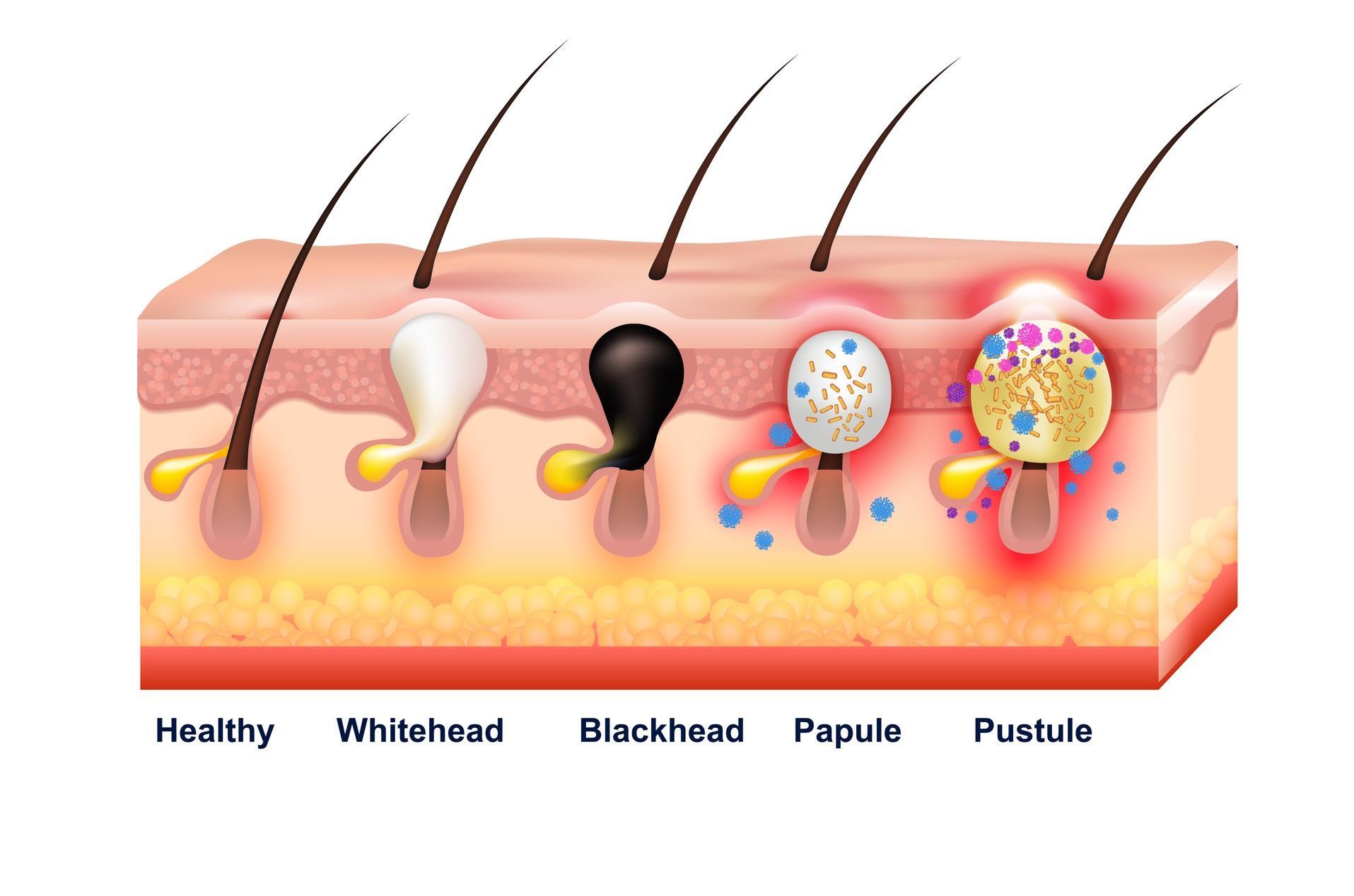 divers types d'acné