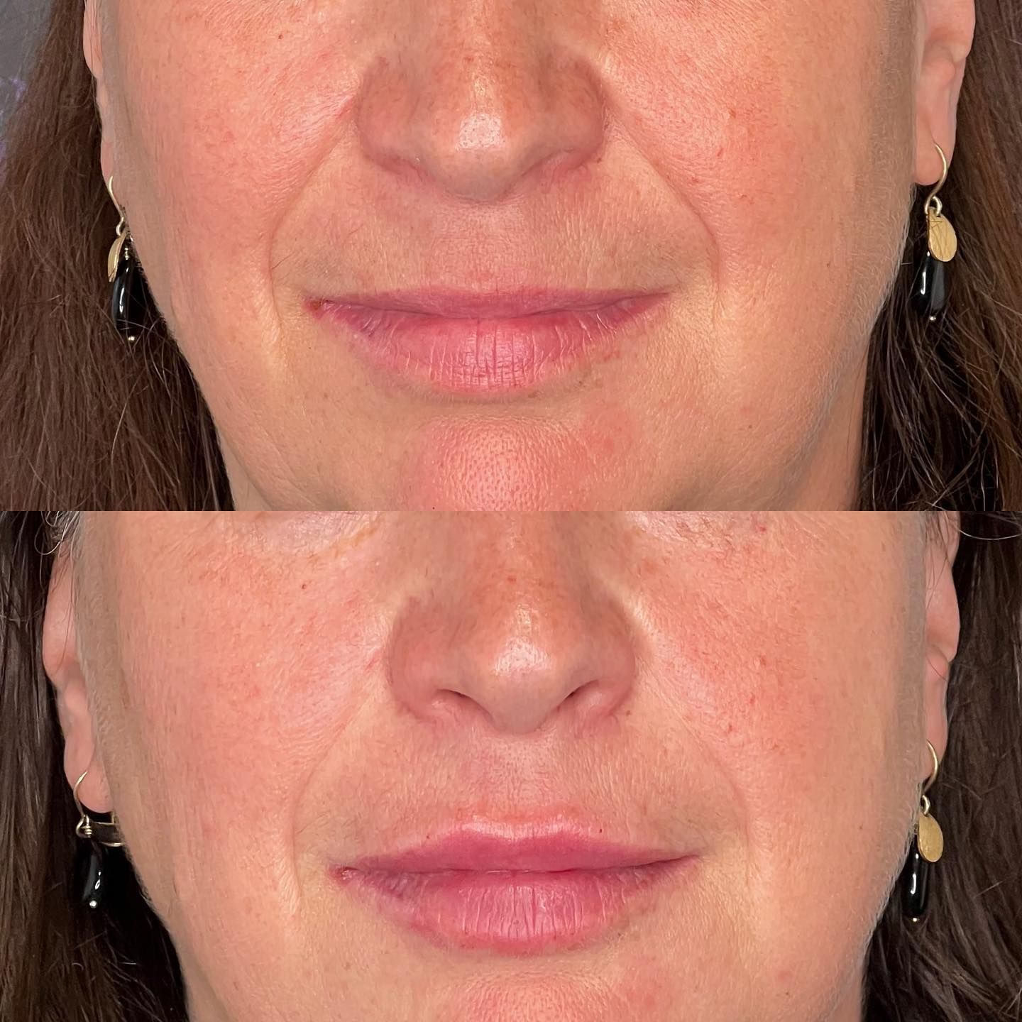 Avant/Après Dr Alain FEBLOT ©