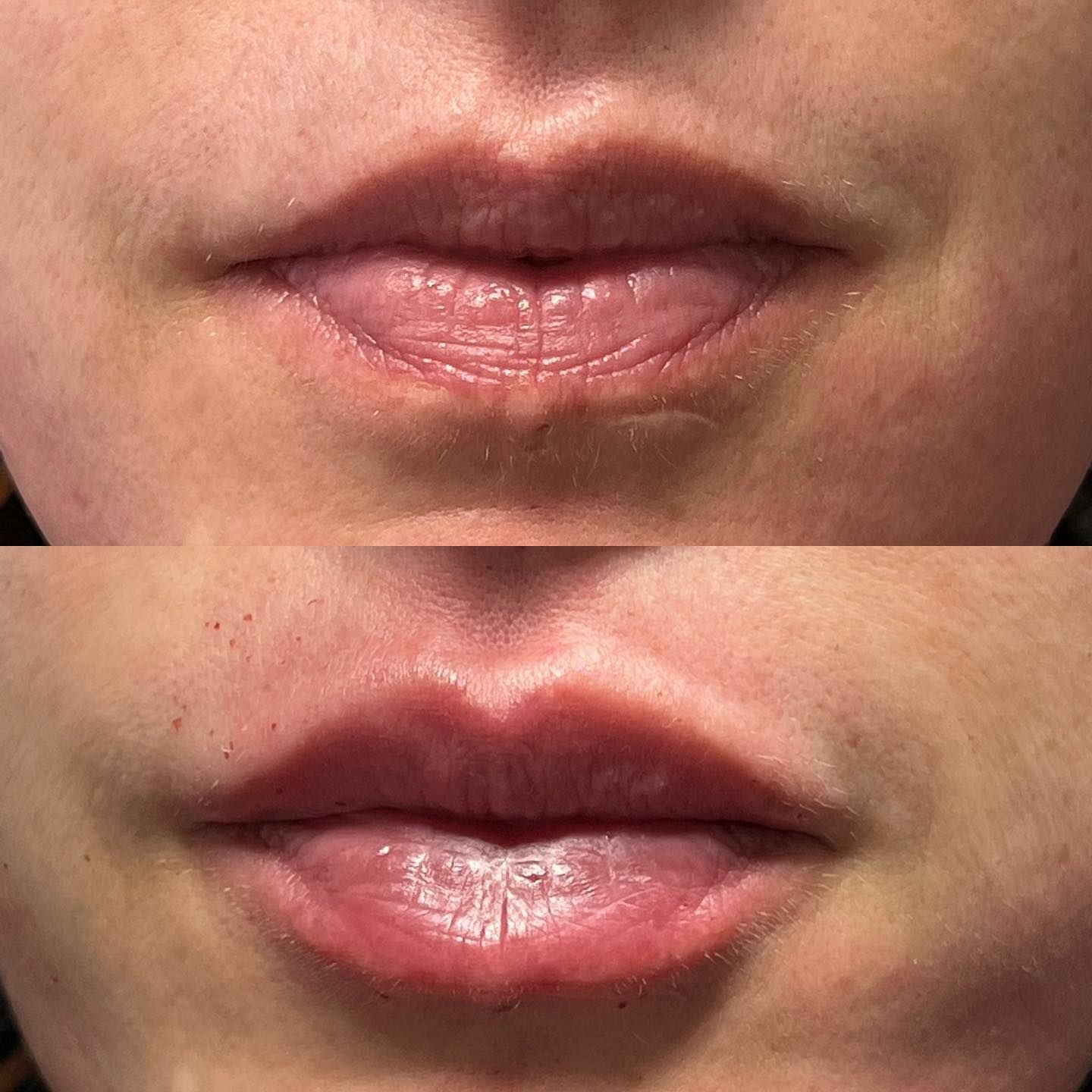 Avant/Après Dr Alain FEBLOT ©