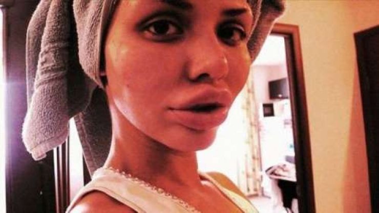 bouche ratée en médecine esthétique