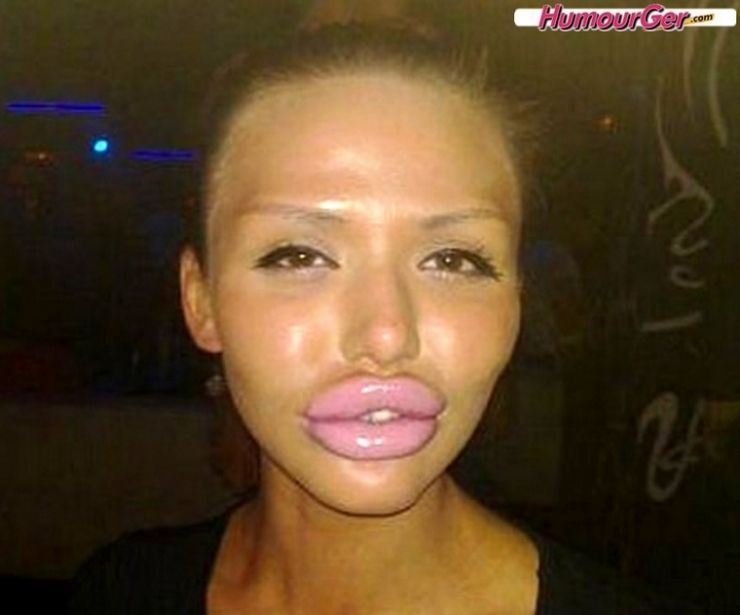 bouche ratée en médecine esthétique