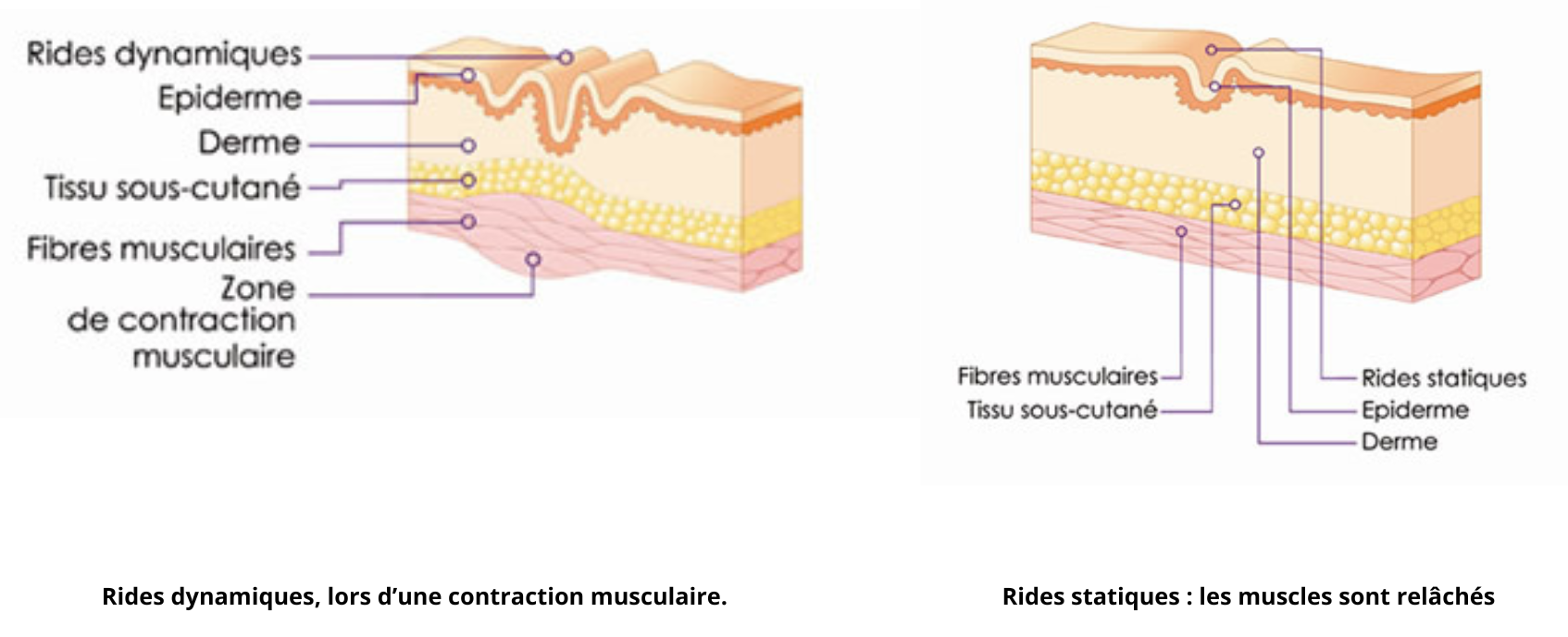 effet du botox sur les rides
