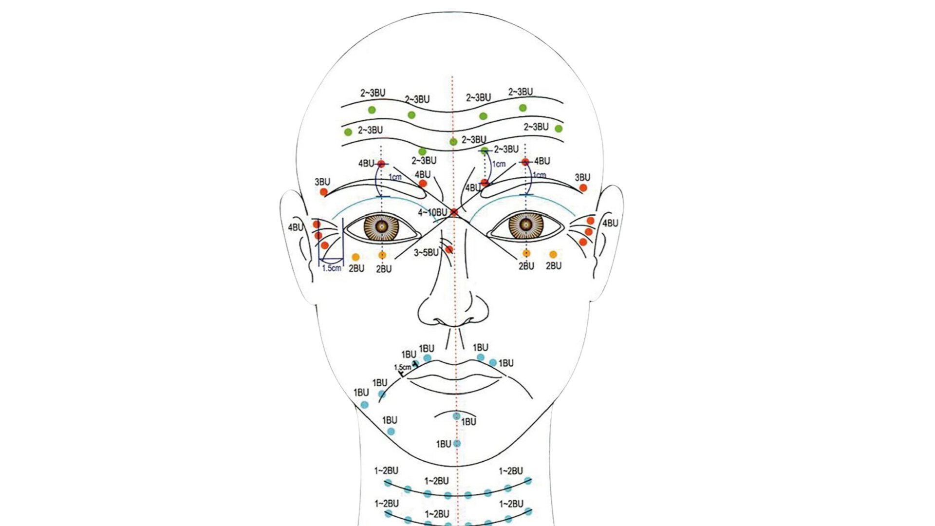 Points d'injection botox