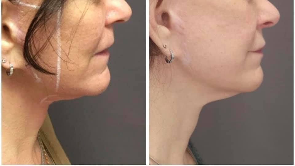 endolift
