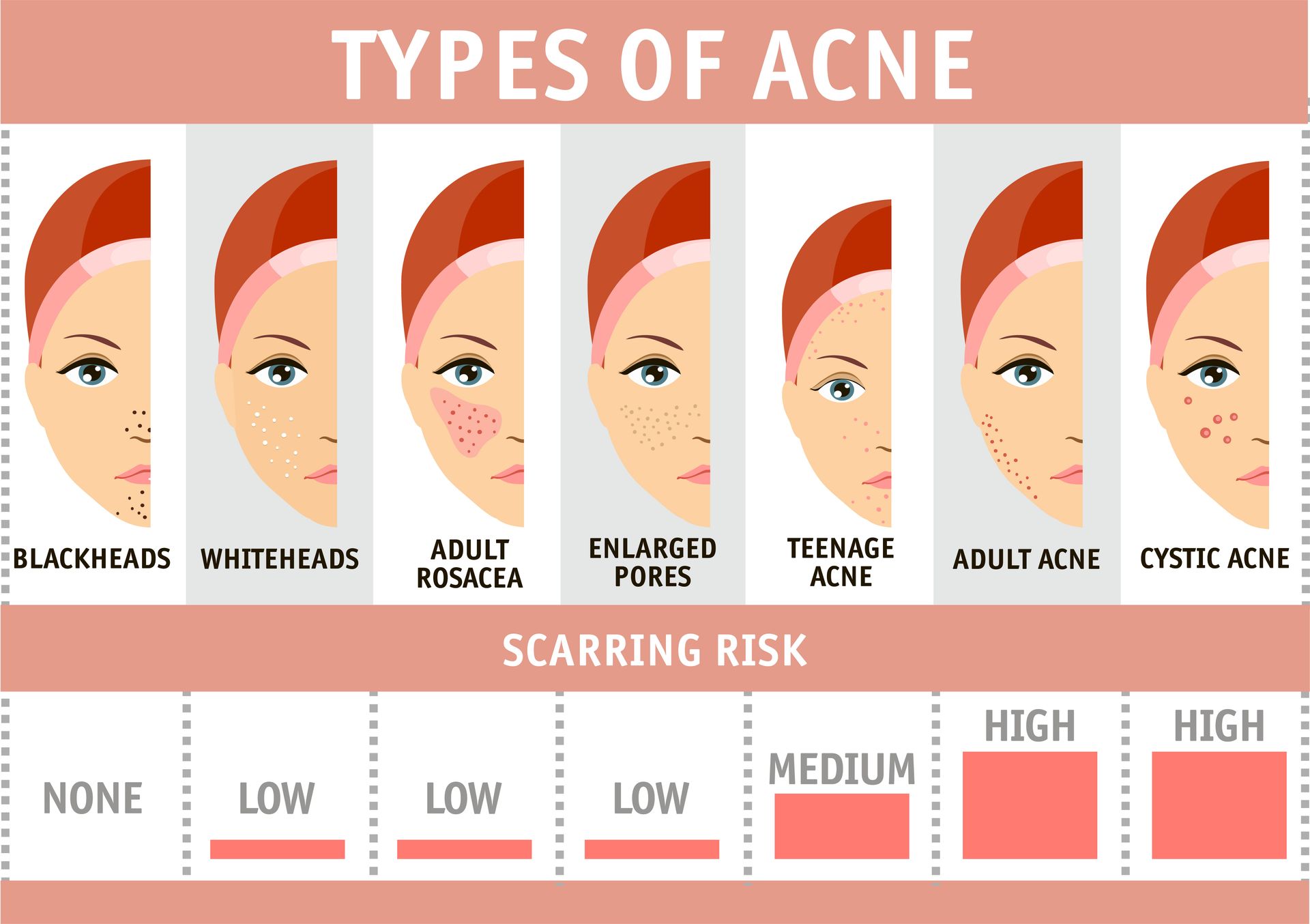 les différent types d'acné et les cicatrices